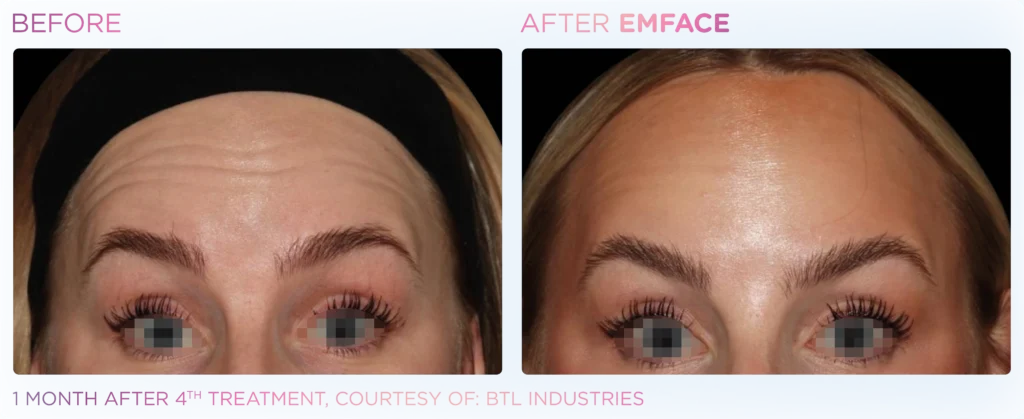 Emface_PIC_Ba-card-female-forehead-099_ENUS100