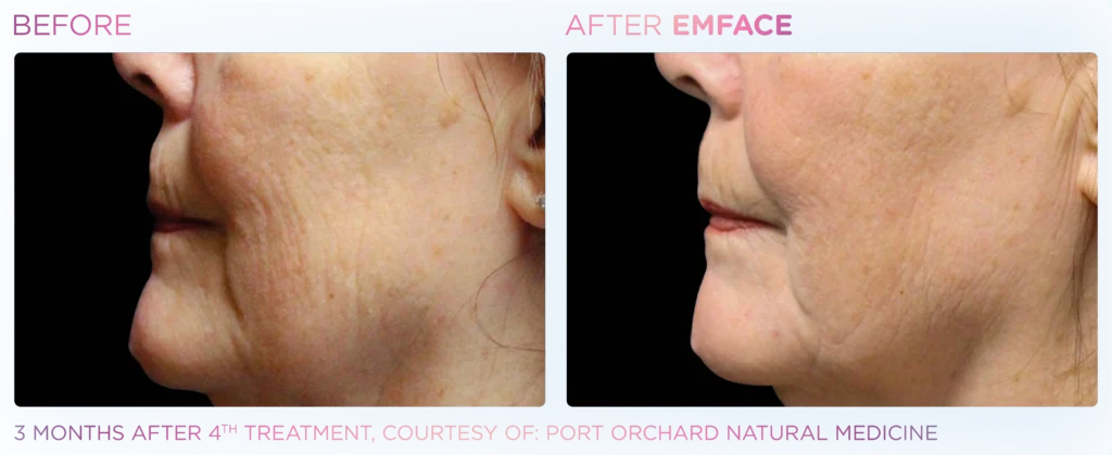 Emface_PIC_Ba-card-female-jawline-090_ENUS100
