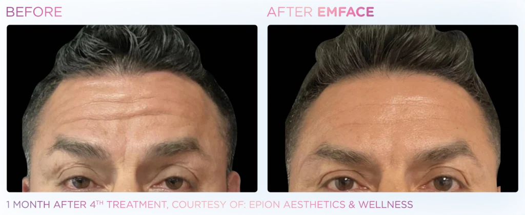 Emface_PIC_Ba-card-male-forehead-093_ENUS100 (1)