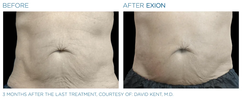 Exion_PIC_Ba-card-abdomen-male-019_Body_ENUS100