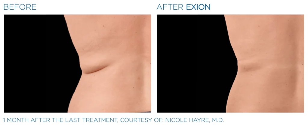 Exion_PIC_Ba-card-back-female-012_Body_ENUS100