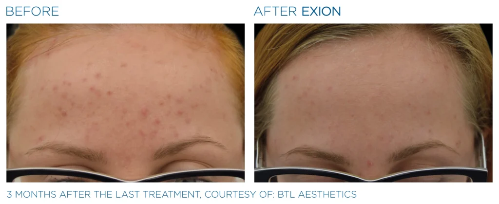 Exion_PIC_Ba