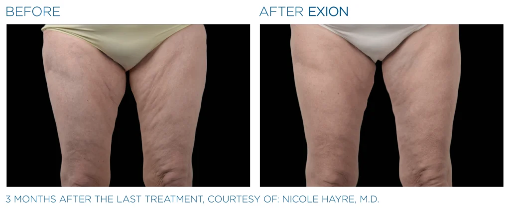 Exion_PIC_Ba-card-thighs-female-033_Body_ENUS100