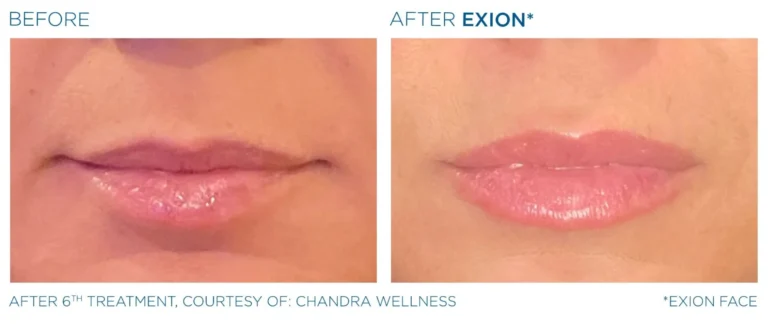 Alternative to Lip Fillers