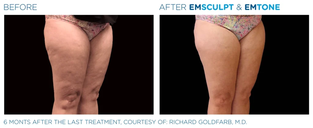Emsculpt_Emtone_PIC_008_Ba-card-female-thighs_ENUS100 (1)