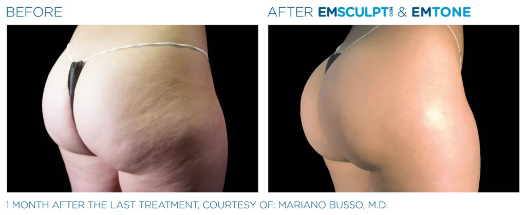 Emsculpt_Neo-Emtone_PIC_Ba-card-female-buttock-008_ENUS100 (1)