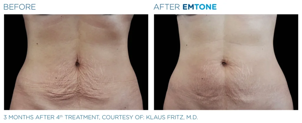 Emtone_PIC_Ba-card-female-abdomen-002_ENUS100 (1)