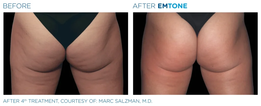 Emtone_PIC_Ba-card-female-buttock-001_ENUS100